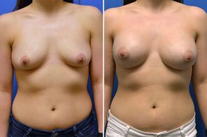 breast-augmentation-255a-branman