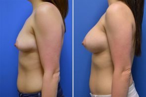 breast-augmentation-255c-branman