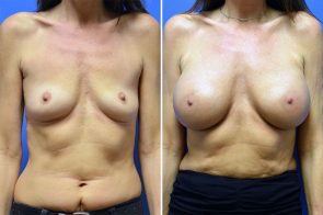 breast-augmentation-257a-branman