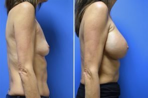 breast-augmentation-257c-branman