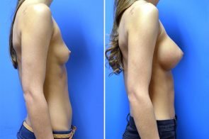 breast-augmentation-258c-branman