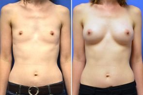 breast-augmentation-259a-branman