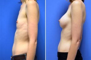 breast-augmentation-259c-branman