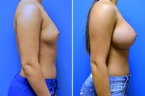 breast-augmentation-260c-branman