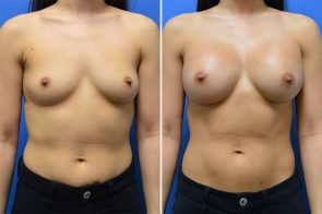 Breast Augmentation Case # 261