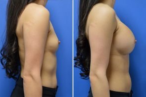 breast-augmentation-261c-branman