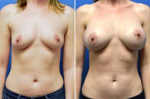 breast-augmentation-262a-branman