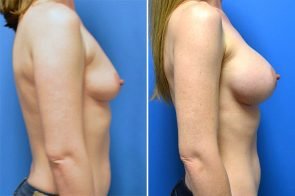 breast-augmentation-262c-branman