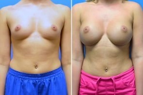 Breast Augmentation Case # 263