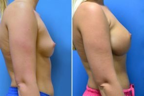 breast-augmentation-263c-branman