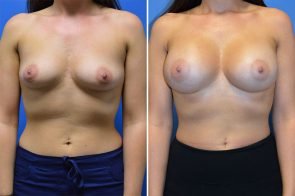 breast-augmentation-264a-branman