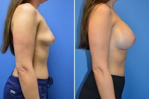breast-augmentation-264c-branman
