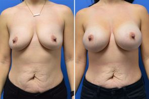 breast-augmentation-265a-branman