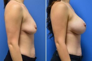 breast-augmentation-265c-branman