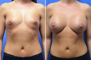 breast-augmentation-266a-branman