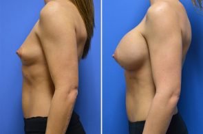 breast-augmentation-266c-branman