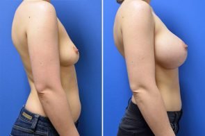 breast-augmentation-267c-branman