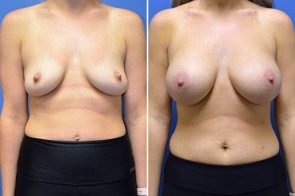 breast-augmentation-269a-branman