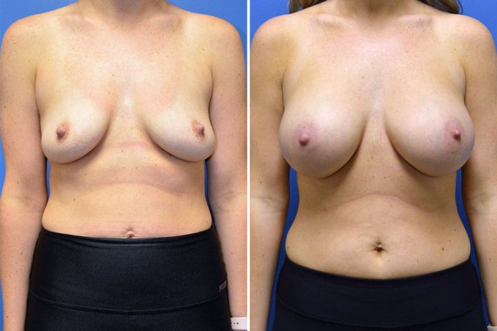 Breast Augmentation Case # 269