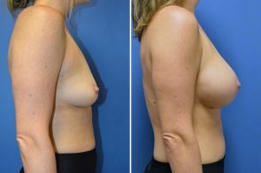 breast-augmentation-269c-branman