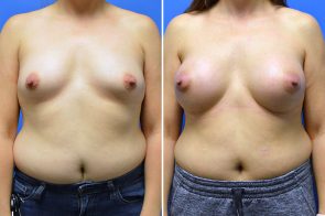 breast-augmentation-270a-branman