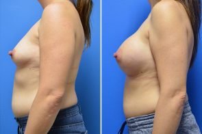 breast-augmentation-270c-branman