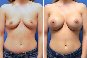 breast-augmentation-271a-branman