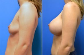 breast-augmentation-271c-branman