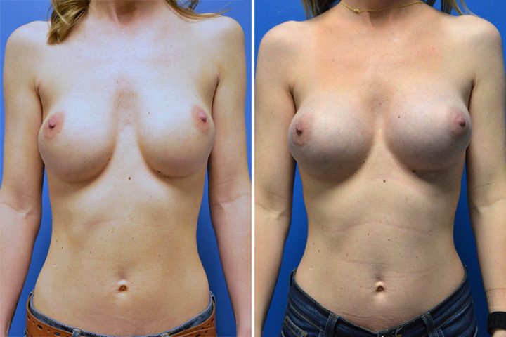 Breast Implant Revision 1