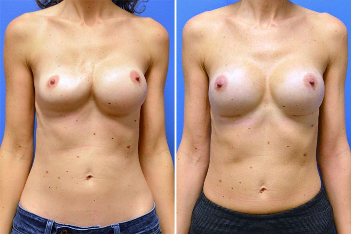 Breast Implant Revision 2