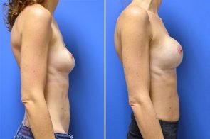 breast-augmentation-revision-244c-branman