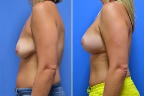 breast-lift-with-augmentation-220c-branman