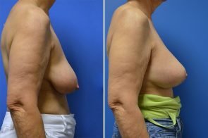 breast-lift-with-augmentation-222c-branman