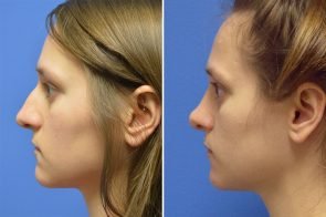 rhinoplasty-150c-branman