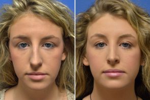 Rhinoplasty Case # 156