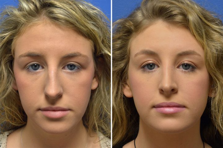 Rhinoplasty Case # 156