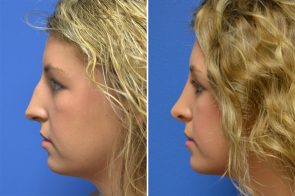 rhinoplasty-151c-branman