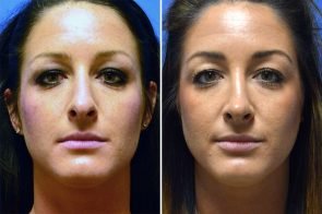 rhinoplasty-152a-branman