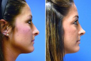 rhinoplasty-152c-branman