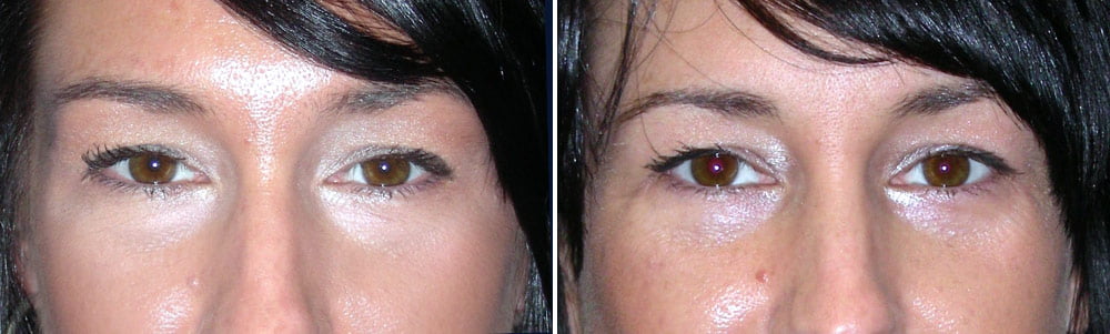 eyelid surgery before and after photos