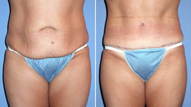 tummy tuck little rock before and after photo