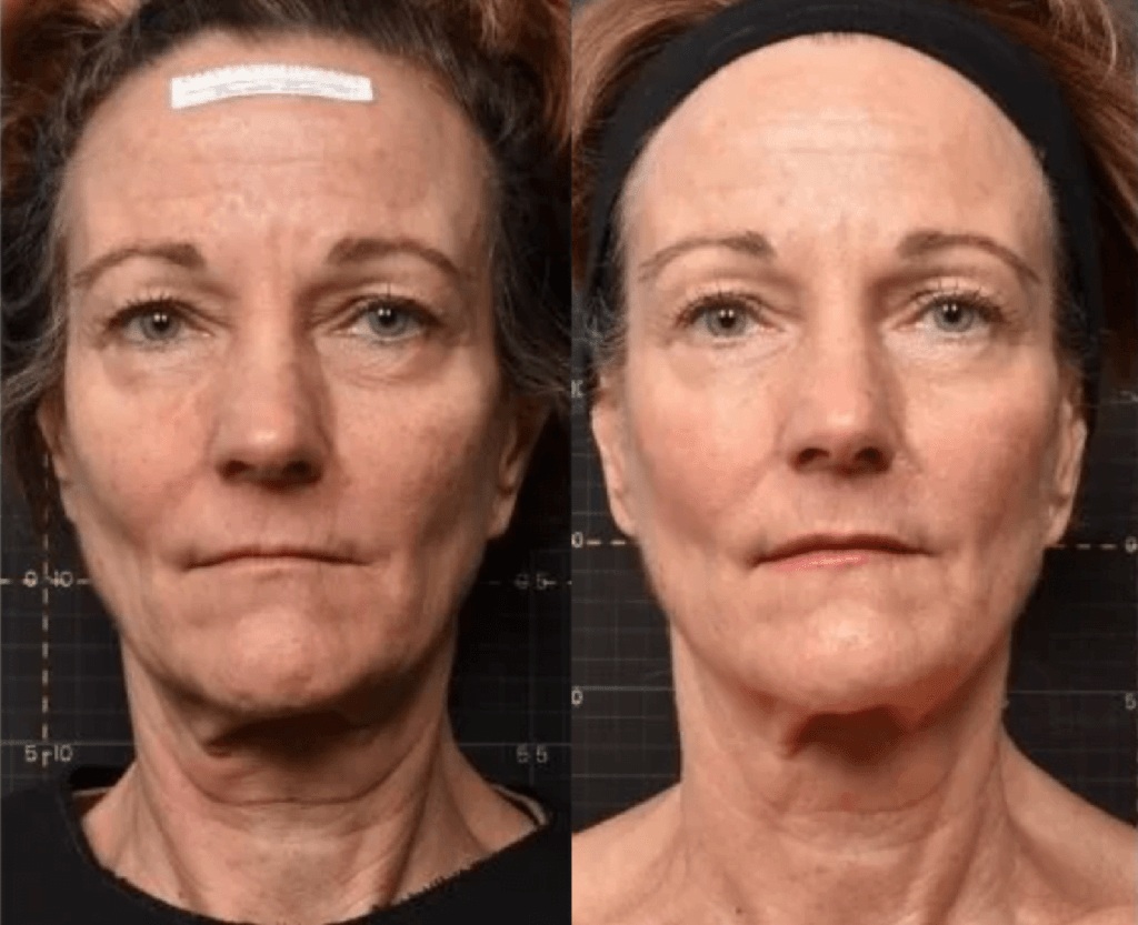 Sofwave NonSurgical Skin Lifting in Little Rock Dr. Rhys Branman