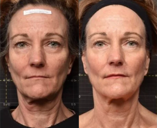 Real patient before and after Sofwave non-surgical skin tightening. treatment