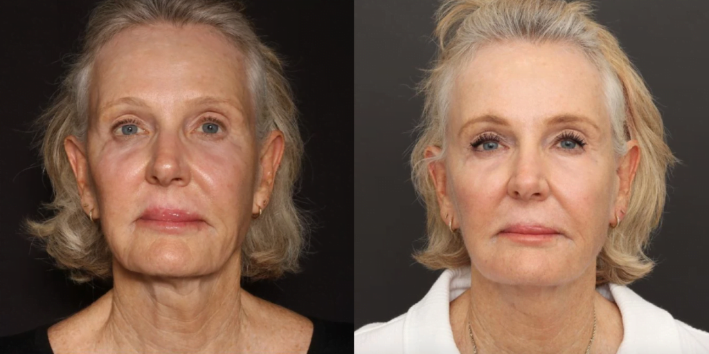 Real patient before and after Sofwave treatment