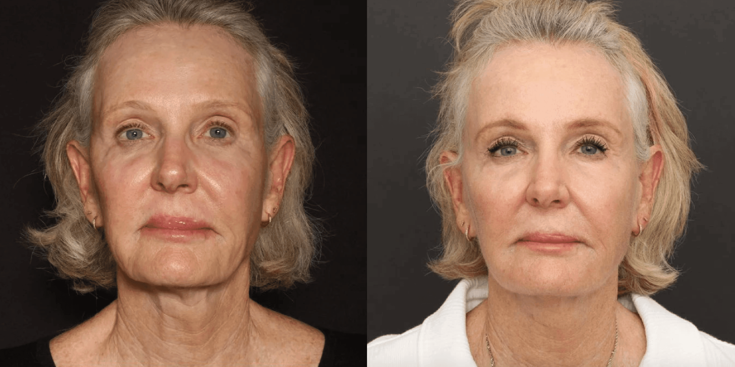 Sofwave Non Surgical Skin Lifting In Little Rock Dr Rhys Branman