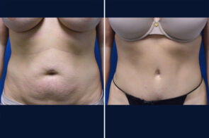 abdominoplasty-26595-2a-gring