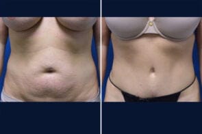 Tummy Tuck Case # 162