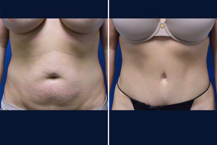 Tummy Tuck Case # 162