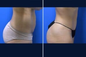 abdominoplasty-26595-2c-gring