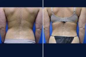 abdominoplasty-26595-2d-gring